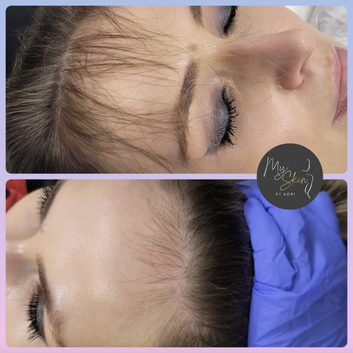 Protocolo de alopecia before and after